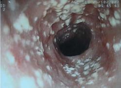 Candidiasis esofágica