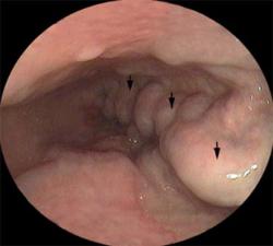 Varices esofágicas