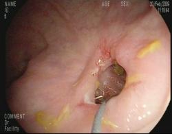 Estenosis colorrectal postquirúrgica