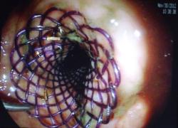Neoplasia de recto estenosante con prótesis biodegradable
