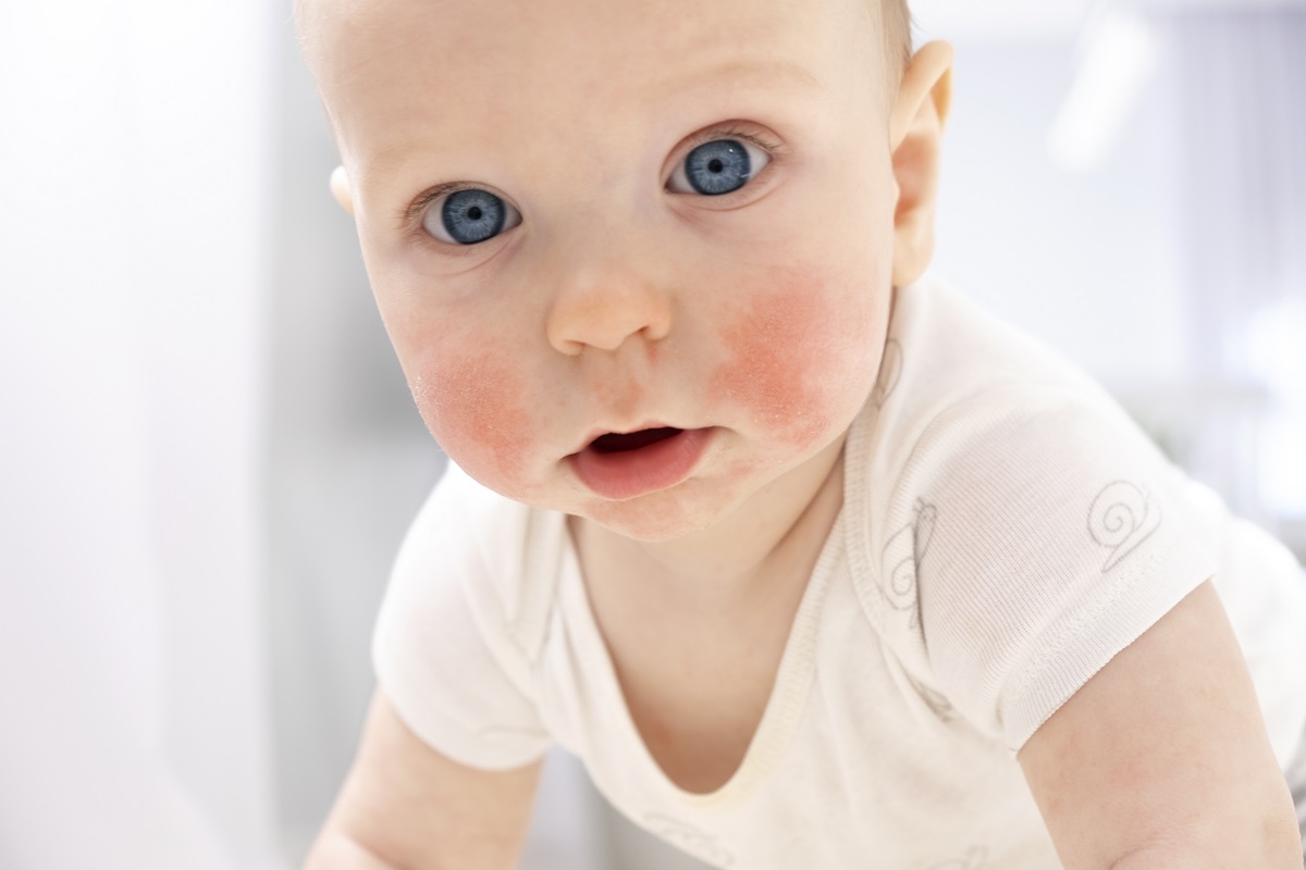 dermatologos infantiles alicante
