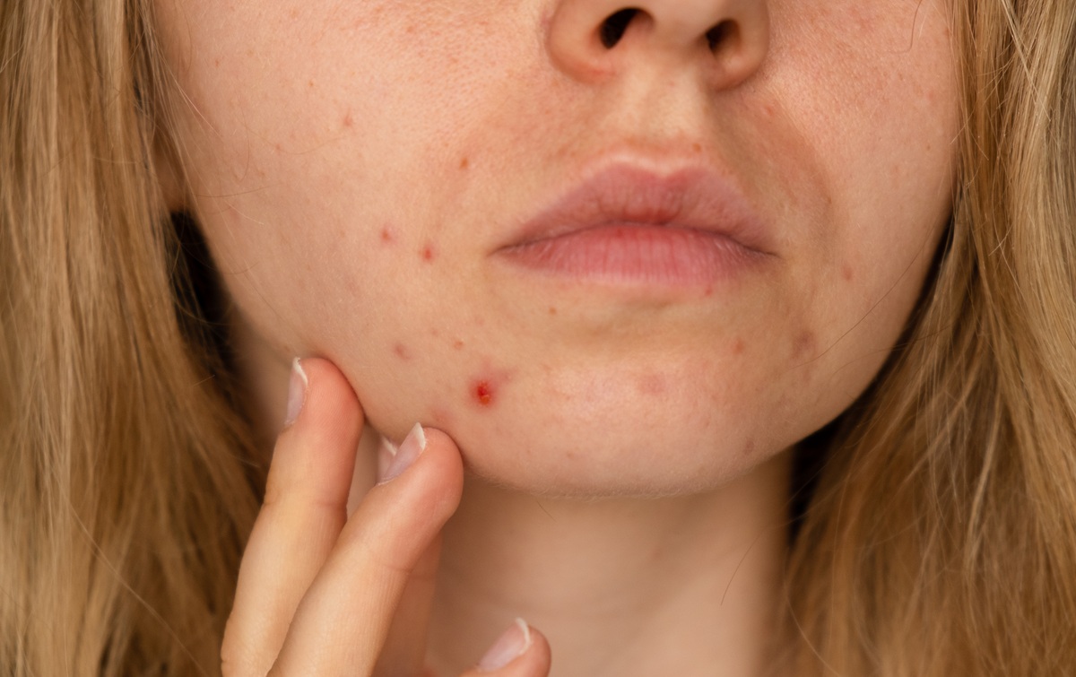 acne tratamiento laser alicante