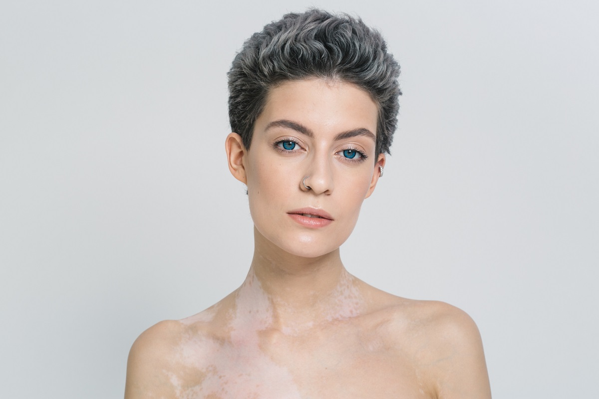 dermatologo vitiligo alicante
