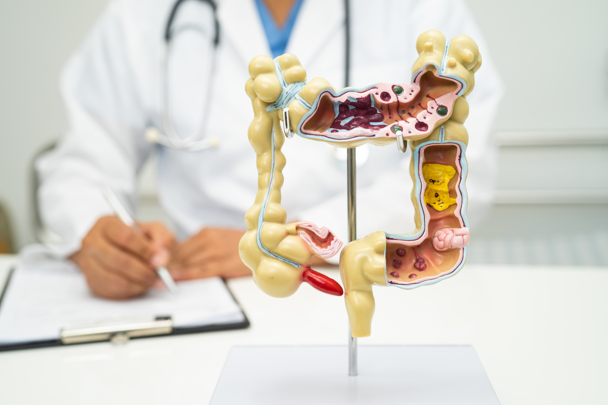 cancer colon alicante