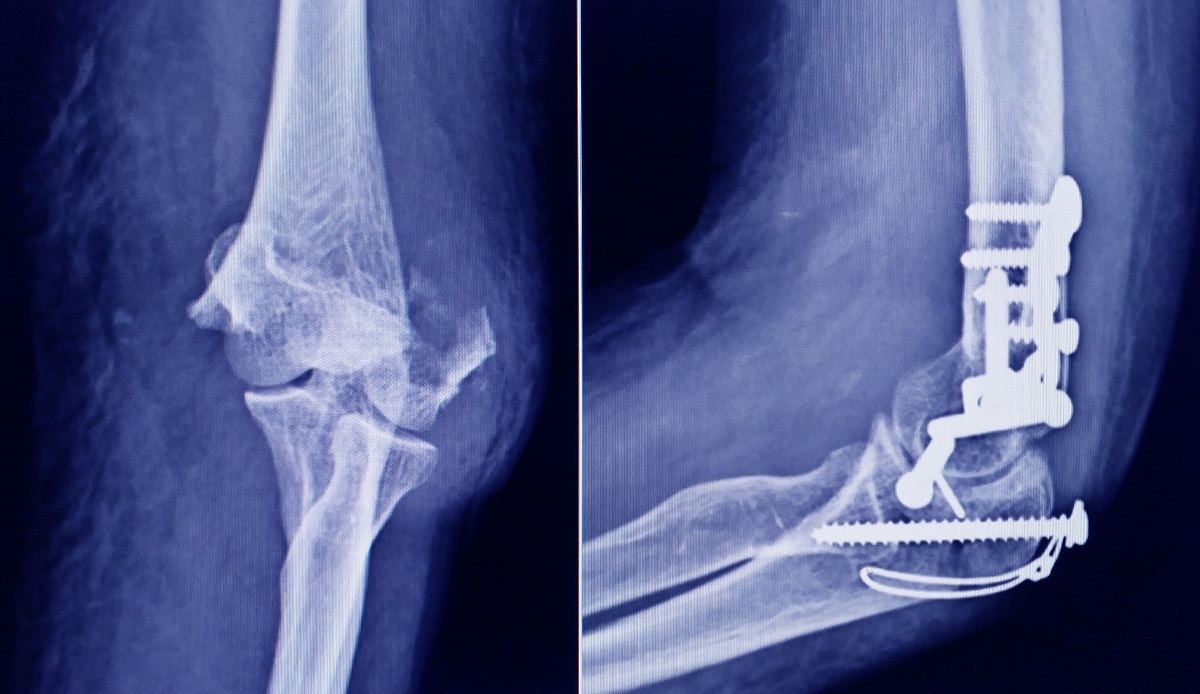 Extracción de material de osteosíntesis en qué consiste Quirónsalud Alicante UCMA