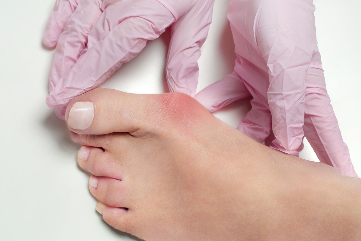 Que es el hallux valgus juanetes Quirónsalud Alicante UCMA