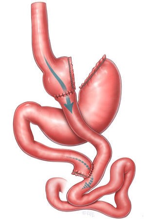 bypass gastrico alicante
