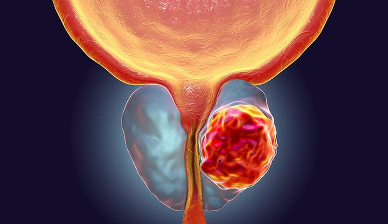 cancer de próstata prevención alicante