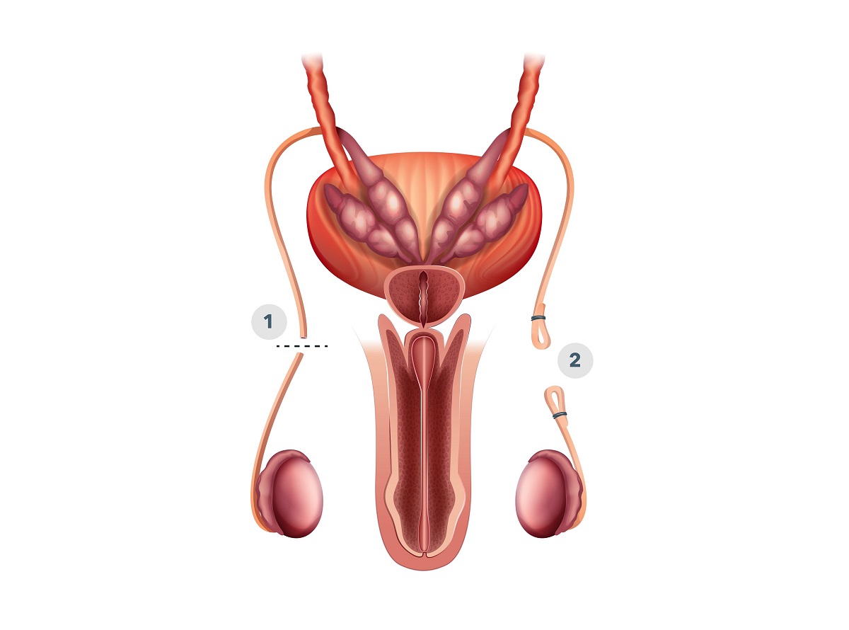 Basektomia: