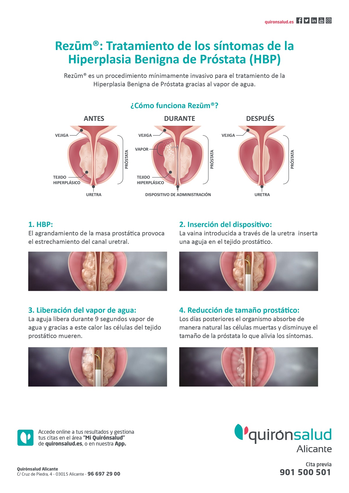 Qué es rezum alicante quirónsalud