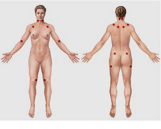 Fibromialgia