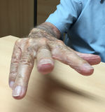 Síndrome de Vaughan-Jackson