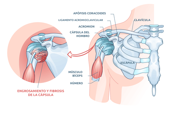 embolizacion arterial