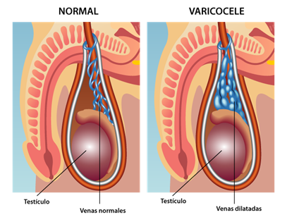 Varicocele produce dolor