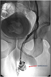 embolizacion de varicocele