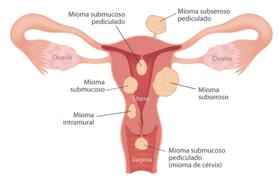 miomas submucosos