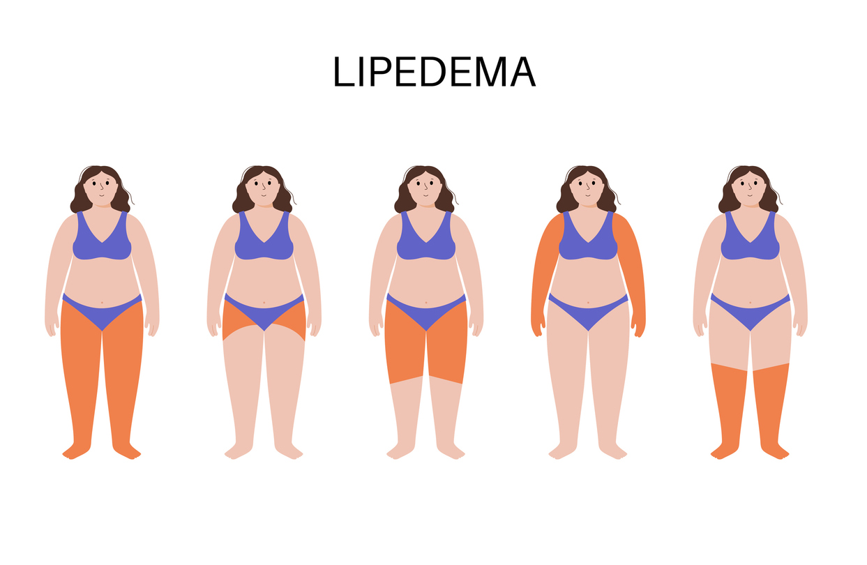 lipedema-quironsalud