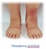 Mixedema