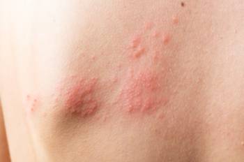 skin-infected-herpes-zoster-virus-herpes-virus-on-2022-01-12-06-09-49-utc