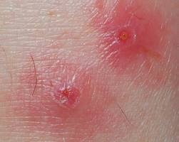 Picadura de mosquito