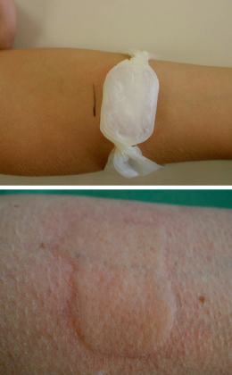 Alergia a Filomena