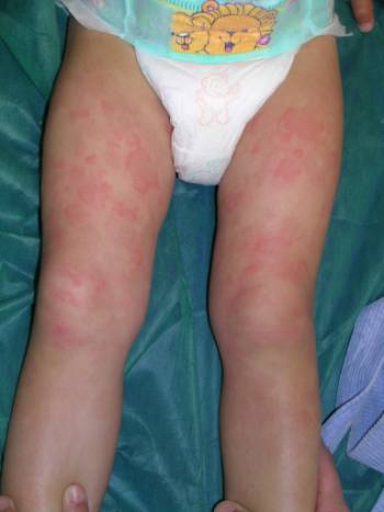 urticaria