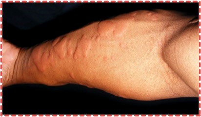 urticaria