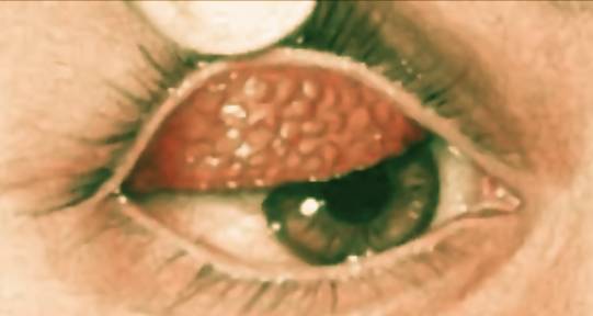 queratoconjuntivitis vernal