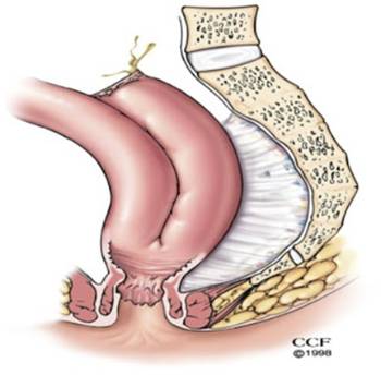 Colitis Ulcerosa