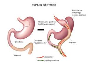 Bypass gástrico