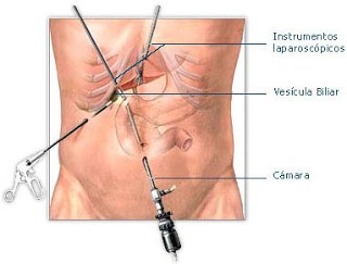 Colelitiasis