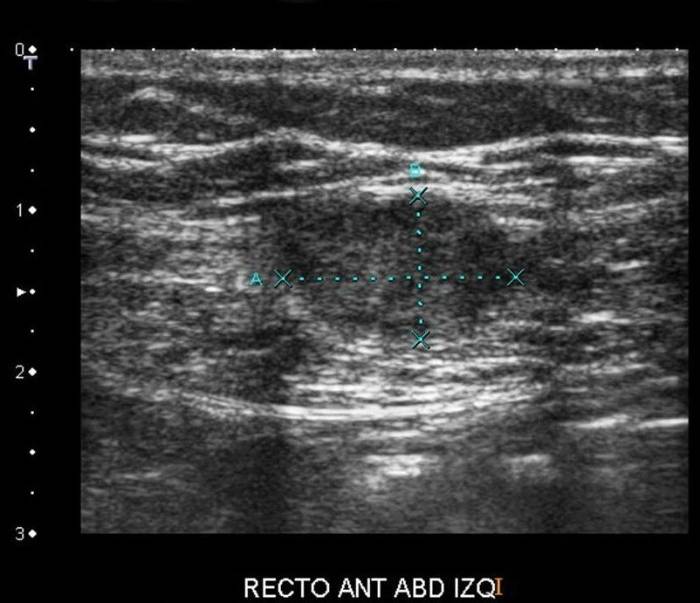 Endometriomas de la pared abdominal