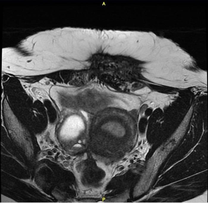 Endometriomas de la pared abdominal