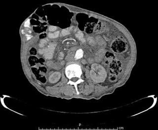 Hernias de pared