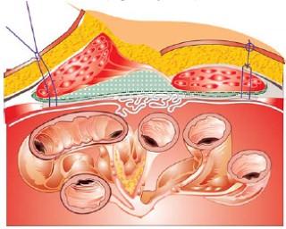 Hernias de pared