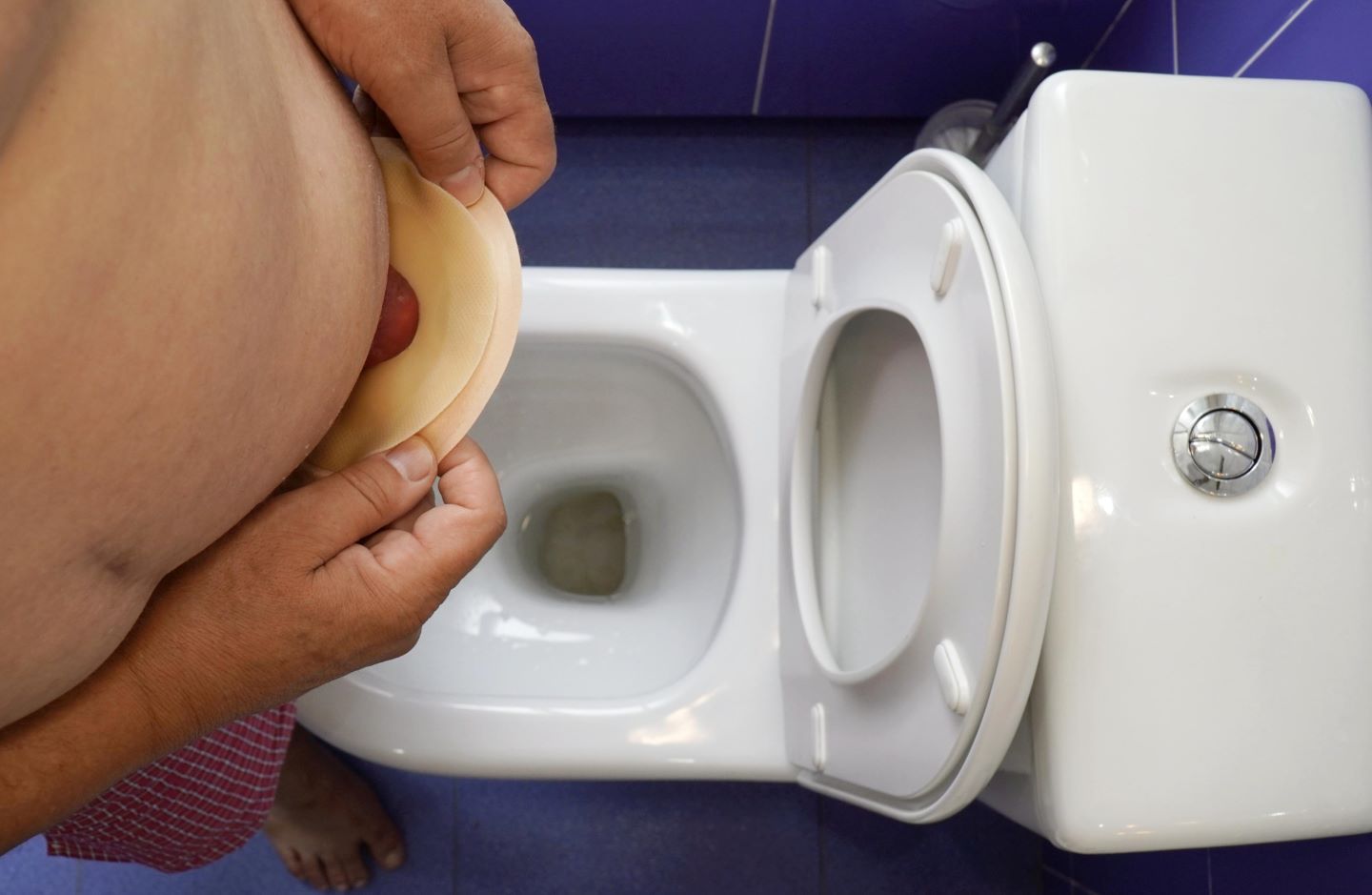 Colostomía