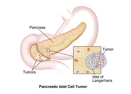 Insulinoma
