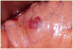 Insulinoma