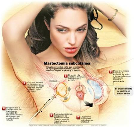 Mastectomía subcutánea