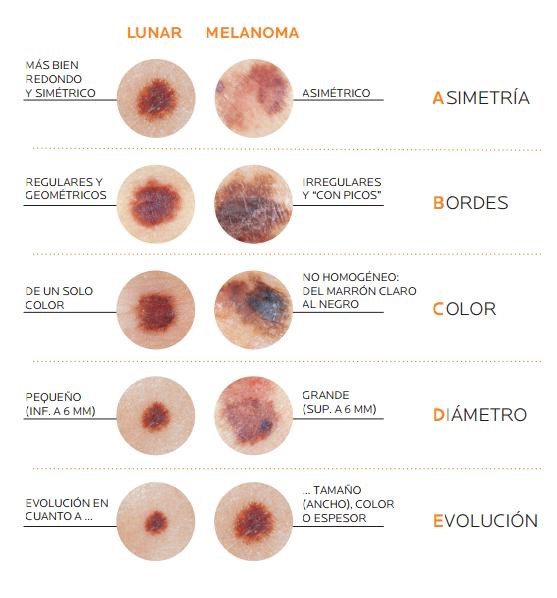 Melanoma_3