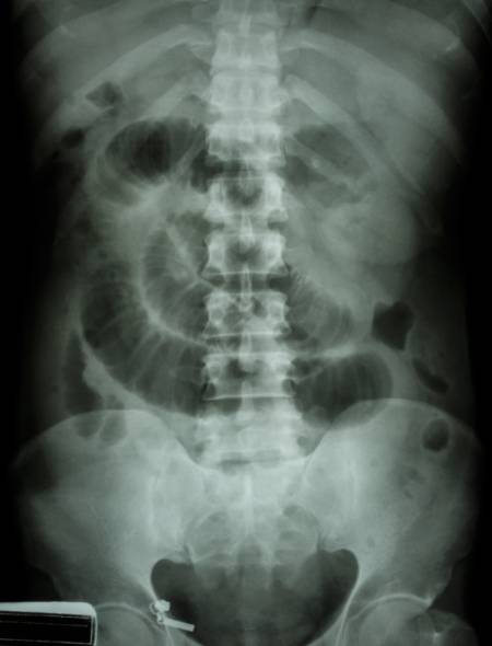 Obstrucción intestinal