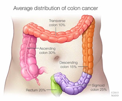 Cáncer de colon