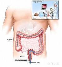 Cáncer de colon