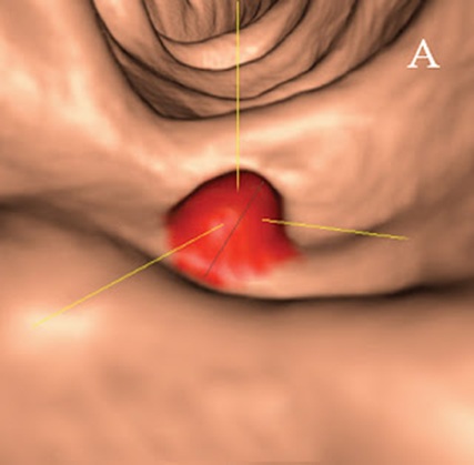 Cáncer de colon