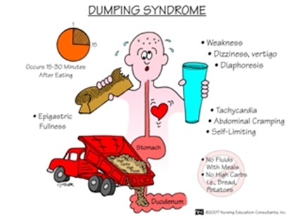 Síndrome de dumping tras cirugía gástrica (bypass antirreflujo) | Blogs ...