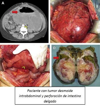 Tumores desmoides