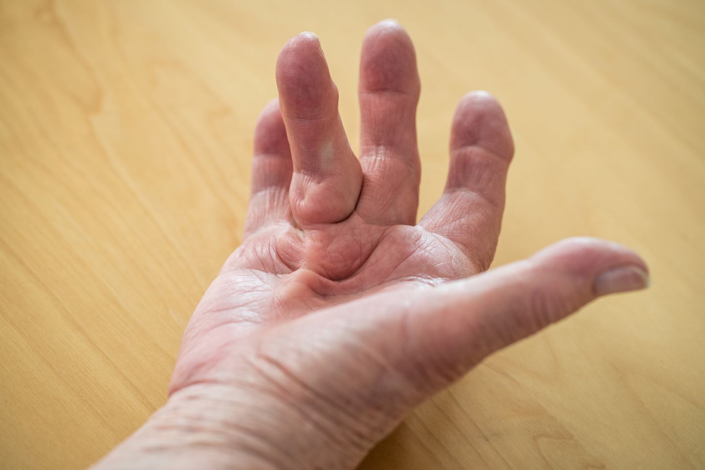 Dupuytren