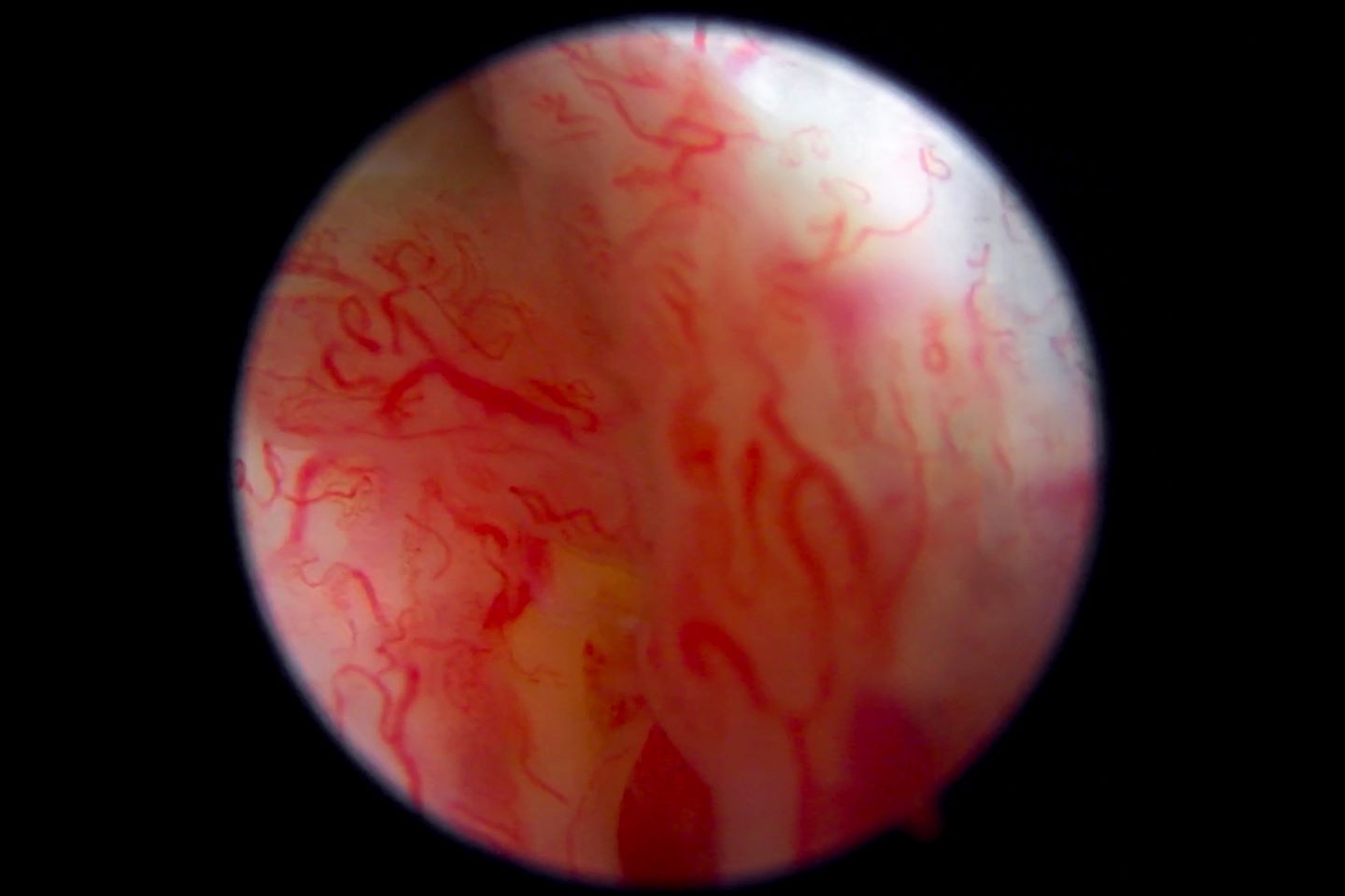 Sinovitis