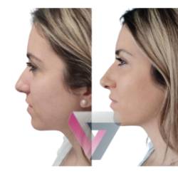 2026 01 19 Rinomodelación o rinoplastia (1)