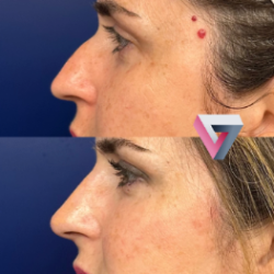 2026 01 19 Rinomodelación o rinoplastia (2)